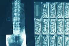 koehler neurochirurgie behandlungsverfahren wirbel